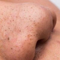 Cách sử dụng trứng gà để trị mụn đầu đen hiệu quả