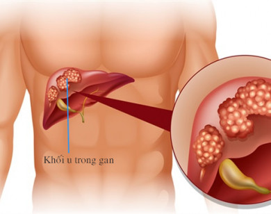 Lưu ý những dấu hiệu cảnh báo ung thư gan 