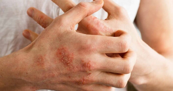 Những vùng da nào trên cơ thể dễ bị nhiễm khuẩn nhất?
