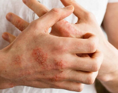 Những vùng da nào trên cơ thể dễ bị nhiễm khuẩn nhất?