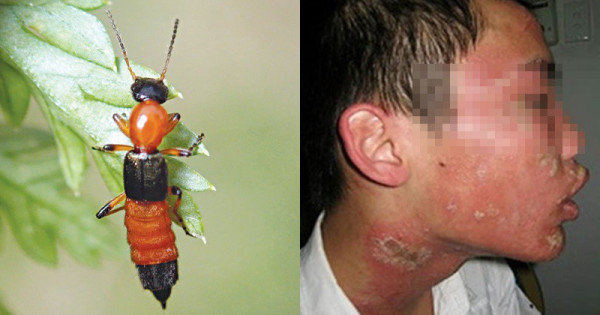 Cảnh báo: Viêm da do kiến ba khoang đốt "tăng đột biến"