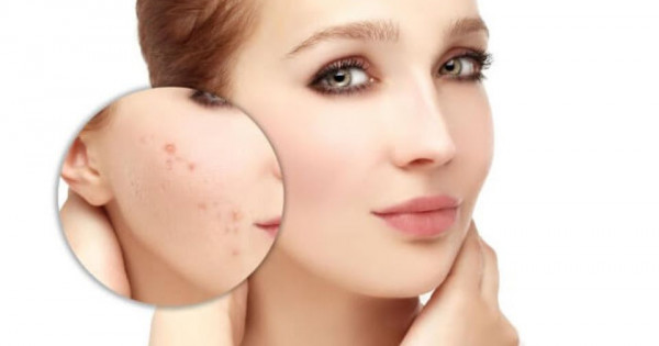 Bật mí 5 cách trị sẹo mụn bằng thảo dược hiệu quả