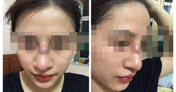 Cô gái 19 tuổi suýt 'thủng mũi" vì dao kéo