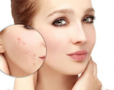 Bật mí 5 cách trị sẹo mụn bằng thảo dược hiệu quả