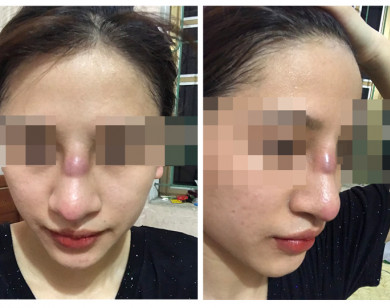 Cô gái 19 tuổi suýt 'thủng mũi