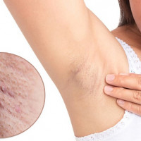 Không cần dùng nhíp lông nách vẫn sạch bong