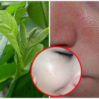 Sạch mụn đầu đen chỉ bằng cách dùng lá ổi