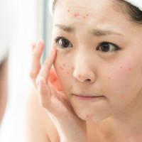 Điều phải biết để điều trị mụn thành công