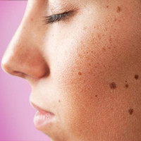 3 điều cần làm tốt để không bị đốm đồi mồi trên da