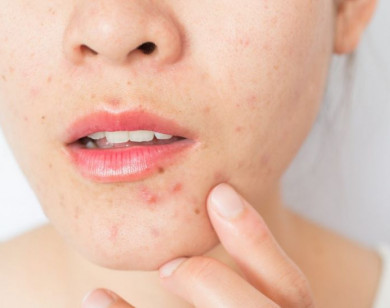 Bí quyết để nặn mụn không để lại vết thâm
