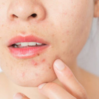 Bí quyết để nặn mụn không để lại vết thâm