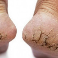 Công thức trị nứt nẻ gót chân trong mùa đông hiệu quả