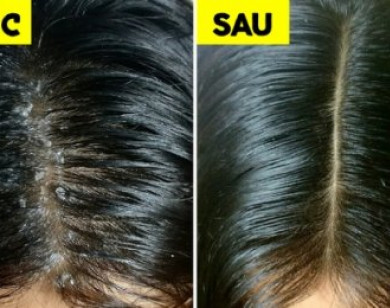 Trị gàu tại nhà mà không cần dùng hóa chất