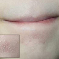 Hỗn hợp đánh bay mụn cám trong nháy mắt