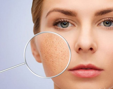 4 nguyên nhân khiến lỗ chân lông của bạn càng ngày càng to