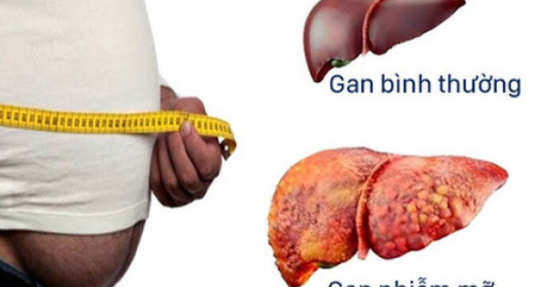 Những điều bạn cần biết về bệnh gan nhiễm mỡ?