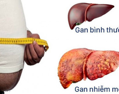 Những điều bạn cần biết về bệnh gan nhiễm mỡ?