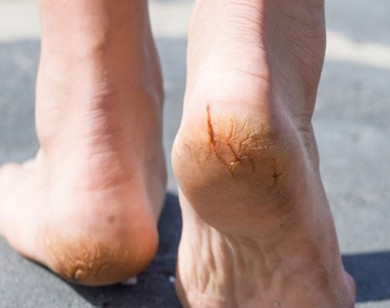 Cách chữa nứt gót chân mùa hanh khô cực đơn giản