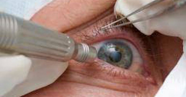 Mắt bị mù vĩnh viễn sau phẫu thuật đục thủy tinh thể tại Bệnh viện mắt Việt Nhật 