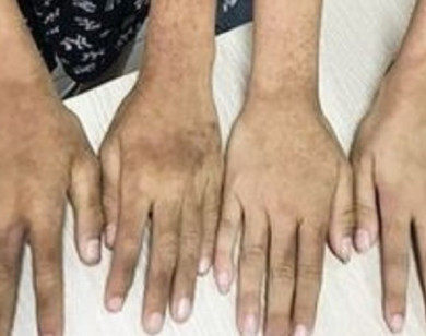 Hà Nội: 2 bé trai mắc bệnh viêm da do ánh nắng và thực vật