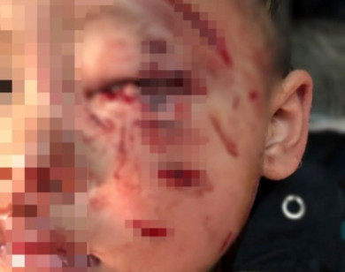 Bé trai 2 tuổi bị chó nhà cắn liên tiếp vào vùng mặt và mắt