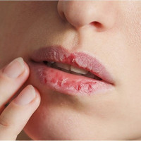 Những thói quen xấu khiến đôi môi nứt nẻ, khô xác