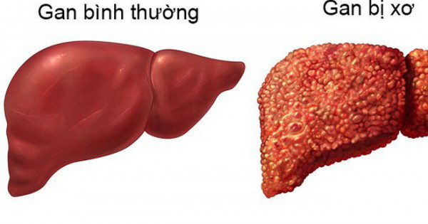 5 nguyên nhân gây xơ gan hàng đầu ở nước ta