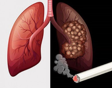 Thanh lọc phổi dành riêng cho người hút thuốc lá