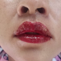 Môi sưng vù, rỉ mủ sau khi xăm môi đón Tết