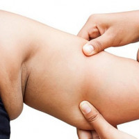 Tại sao bắp tay lại bị tích mỡ?
