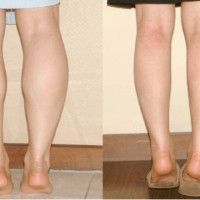 Phương pháp thu nhỏ bắp chân đơn giản nhưng không nhiều người biết
