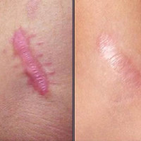 Cách làm kem trị sẹo tại nhà không tốn tiền