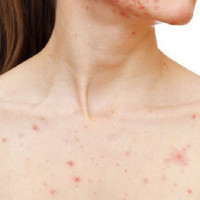 Giải quyết mụn trứng cá ở ngực đơn giản