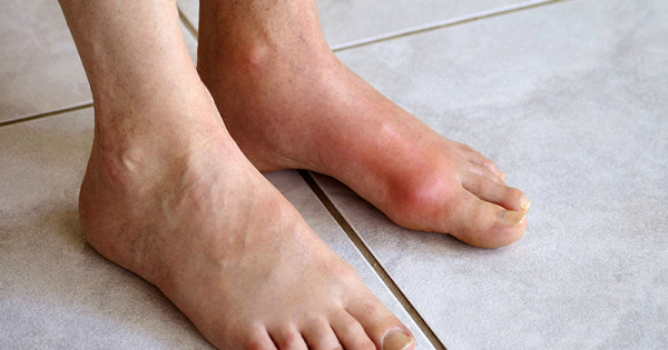 Cách giúp bạn phòng chống bệnh gout