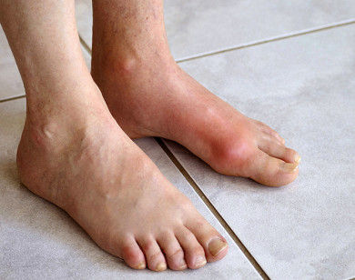 Cách giúp bạn phòng chống bệnh gout