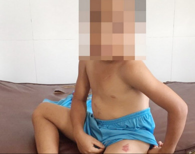 Sóc Trăng: Bé trai 6 tuổi bị cha dượng bạo hành, châm thuốc lá vào người