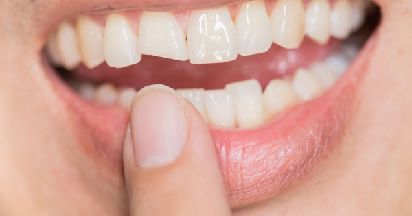 Mảng bám trên răng hình thành như thế nào?