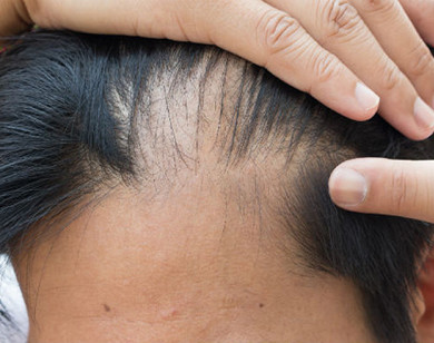 Làm sao để ngăn rụng tóc thời kỳ mãn kinh?