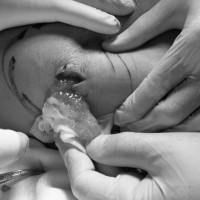 Cô gái trẻ bị nhiễm trùng mặt nghiêm trọng sau 3 năm tiêm filler