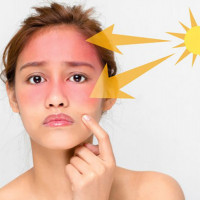 Điều bạn tuyệt đối không nên làm khi da bị cháy nắng