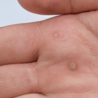 Mụn cóc và những điều bạn cần biết