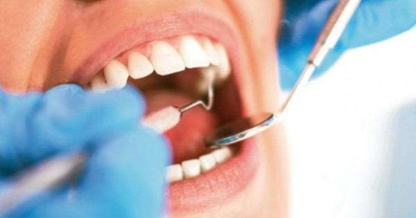 Biến chứng sau khi nhổ răng bạn không thể coi thường