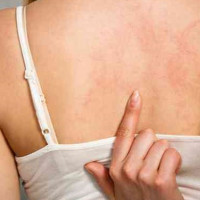 Cải thiện vấn đề về da thường gặp trong mùa đông