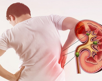 Yếu tố làm tăng nguy cơ bị sỏi thận