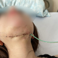 Tiêm tan mỡ nọng cằm, cô gái bị hoại tử vùng cổ nặng