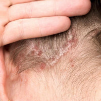 2 cách tự nhiên giúp trị vảy nến trên da đầu hiệu quả