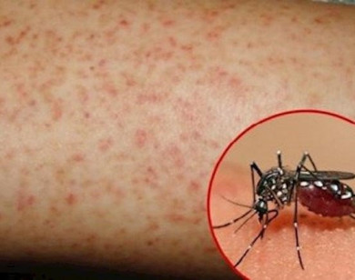 Cách phòng bệnh sốt xuất huyết trong mùa hè