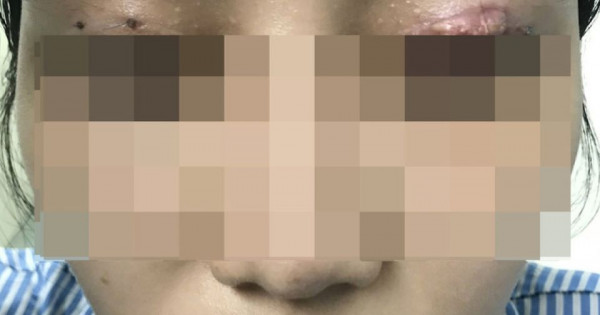 Nữ bệnh nhân bị hỏng mắt do cắt mí tại thẩm mỹ viện "chui"