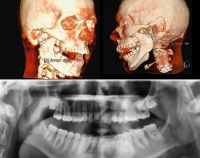 Bệnh nhân người Pháp bị gãy xương hàm hiếm gặp được phẫu thuật thành công tại Việt Nam