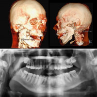 Bệnh nhân người Pháp bị gãy xương hàm hiếm gặp được phẫu thuật thành công tại Việt Nam